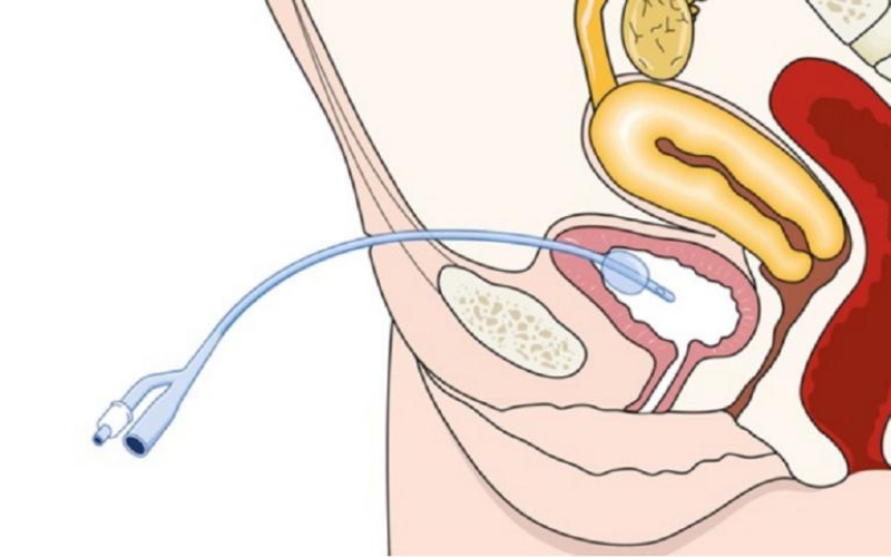 các loại ổng thông tiểu